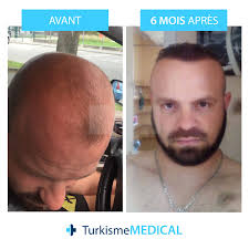 Dirigeants officiels du dr serkan aygin pour. Changement Radical Avec La Greffe De Cheveux Greffe De Cheveux Implant Capillaire Greffe