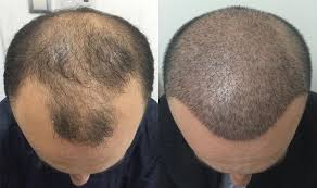 تكلفة زراعة الشعر في تركيا Class Hair