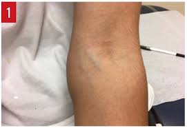 Image result for Radial Head Dislocation