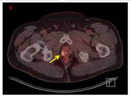 Your guide to what a ct scan is and how it is used to stage testicular cancer the stage of the cancer means how big it is and whether it has spread. Pet Ct For Prostate Cancer From Diagnosis To Metastasis Renal And Urology News