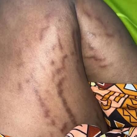 FINIES les VERGETURES, même les plus anciennes ! ❌❌ Découvre la GELÉE  VERGETURES ULTRA PUISSANTE, une révolution cosmétique 100% naturelle qui  élimine définitivement TOUTES sortes de vergetures : • Anciennes ou récentes