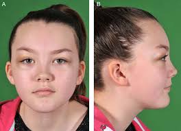 Precursor B cell lymphoblastic lymphoma presenting as periorbital swelling