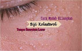 Apakah petua dan cara hilangkan jeragat yang berkesan? Hilangkan Biji Kolesterol Di Muka Tanpa Laser Yang Sakit Ohcantik Com