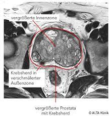 Psa Wert Was Sagt Er Aus Ab Wann Prostatakrebs Mit Psa Tabelle