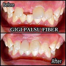 Gigi palsu nyaman kuat, harga termurah, bergaransi. Drwhite Memang Suka Gigi Palsu Klinik Pergigian Dr White Facebook