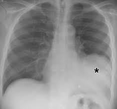 Image result for Chest XRay