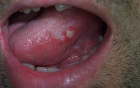 Home Remedies For Canker Sores On Tongue Canker Sore On Tongue Tongue Sores Canker Sore Remedy
