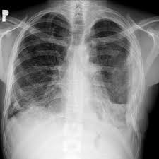 Chest X Ray Left Sided Massive Hemothorax Download Scientific Diagram