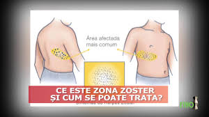 Dureri Articulare Cu Zona Zoster Durere SeverÄƒ È™i Crize La Nivelul ArticulaÈ›iilor