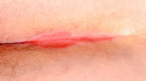 Image result for itchy skin rectum