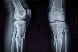 Image result for Knee XRay