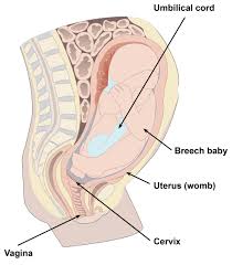 Image result for Breech Presentation
