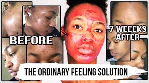 2 415 547 просмотров • 13 янв. I Look Like This 7 Weeks After Using The Ordinary Aha 30 Bha 2 Peeling Solution Tashika Bailey Youtube