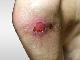 Pressure Ulcers