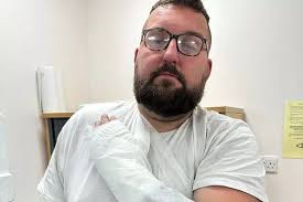 Exploding vape set fire to man's beard and melted into his hand