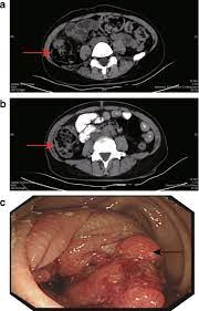 It is often done before surgery (see types of treatment). Abdominal Ct Scan Colon Cancer Ct Scan Machine