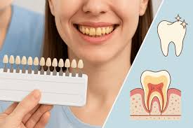 Image result for Tooth Discoloration