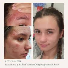 Hi Renee, last time we communicated was late April where I sent you some  photos of my daughter. I am now sending you her latest photo.....the  difference is amazing and it is