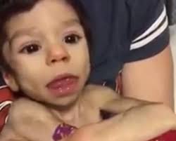 Un niño demacrado tuvo una recuperación increíble después de que lo  adoptaran