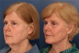 Facelift Before and After Photos by Ronald Schuster, MD; Lutherville, MD