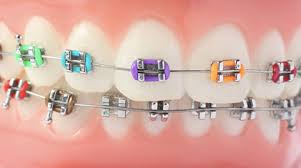 See more of apparecchio ortodontico on facebook. Apparecchio Per I Denti Puo Causare Danni Collaterali
