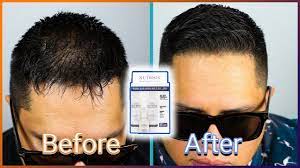 Heredity, thyroid levels and even frequent use of a flat iron can also be to blame. Thinning Hair Balding Watch This Nutri Ox Product Review Youtube