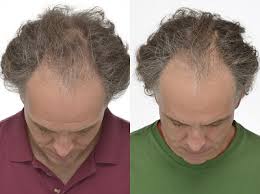 Hair growth before & after. Igrow Hair Growth System Fitboxx