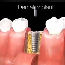 Irate Dental Care Truths Teethwhiteningmiami Toothimplant In 2020 Dental Implant Procedure Dental Implants Dental