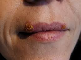 After your chickenpox are gone, the varicella virus stays in your body as an inactive virus. Lippenherpes Behandlung Verlauf Ursachen Onmeda De