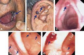 Blue Rubber Bleb Nevus Syndrome Gastrointestinal Endoscopy