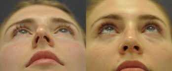 Mark Been, MD, Board Certified Facial Plastic Surgeon