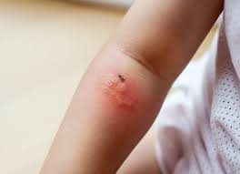 Image result for mosquito bite