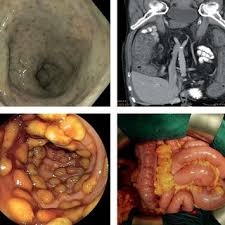 Symptoms include watery diarrhea, fever, nausea, and abdominal pain. Pdf Clostridium Difficile Infektion Leitliniengerechte Diagnostik Und Behandlungsoptionen
