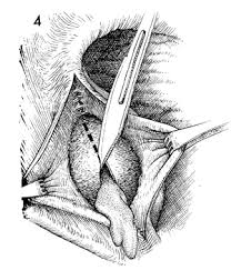 Image result for Bartholin's gland abscess