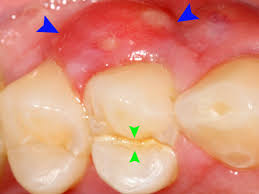 The dentist will most likely try to drain the abscess first by making a small incision, ideally after administering anesthesia around the painful area, and allowing the pus to flow out. Bump On Gums Causes And How To Treat Them