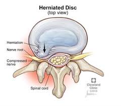 49 years experience physical medicine and rehabilitation. Sciatica Causes Symptoms Treatment Prevention Pain Relief