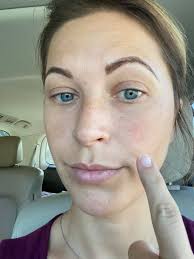 Skin Issues and Tick Bites