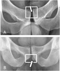 Image result for Pubic Apophysitis