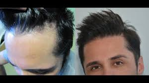 Individuals with scars, or those who have lost hair due to various diseases, can also safely undergo a hair transplant surgery. Frontal Hairline Restoration Hairline Implants Dr Doganay Youtube