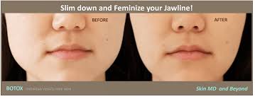 You're likely here because you've read that botox can tighten and lift the jaw line. Botox For Jaw Pain Plano Tx Bruxism Treatment Frisco Tx