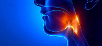 Cancerous tumors of the throat, tongue or voice box (larynx) can cause a sore throat. One Singer S Sore Throat Turned Out To Be Cancer Moffitt
