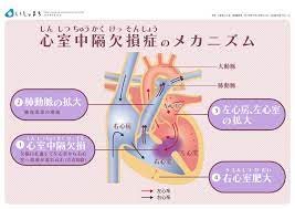 心室中隔欠損症のメカニズム infographics 先天性心疾患 看護ノート 循環器内科