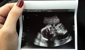 An nt measurement of up to 2mm is normal at about 11 weeks, and up to about 2.8mm by 13 weeks and six days. Nuchal Translucency Scan Foresight Prenatal Clinic Bangladesh