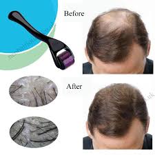 Microneedling has also been shown to have some effect on slowing or reversing hair loss. Can Microneedling Cause Temporary Hair Shedding How To Use The Dermaroller To Regrow Hair Stop Hair Loss And Grow Hair On Receding Hairline Youtube Regrowha Regrow Hair Stop Hair Loss Thick
