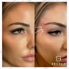 Much as i agreed with him that an eye lift was probably needed, i have vowed never to go under the knife. Introducing The Cat Eye Look We It S A Secret Med Spa