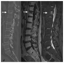 Image result for Vertebral Compression Fracture