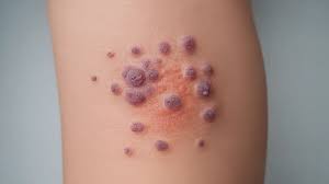 Image result for Vasculitis