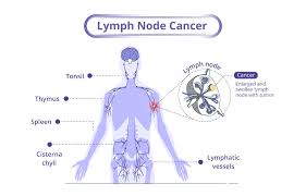 Image result for Lymphoma