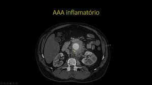 The aorta gives off several major branches as it passes from. Aneurisma Inflamatorio Da Aorta Abdominal Youtube
