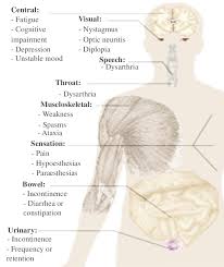 Check spelling or type a new query. Ms Main Symptoms 30 Https En M Wikipedia Org Wiki Multiple Sclerosis Download Scientific Diagram